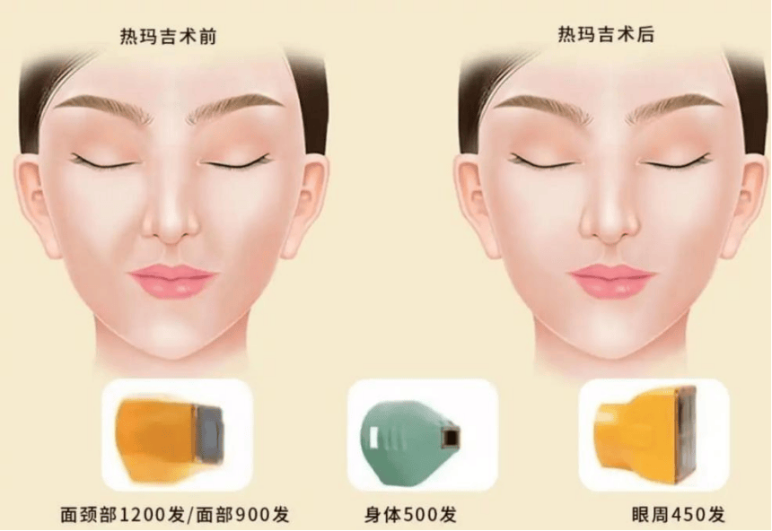 一文揭秘：热玛吉的功效作用及副作用？