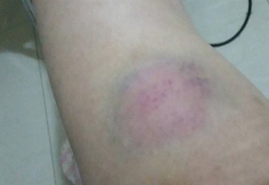 筋膜枪的作用：提防3大副作用危害！